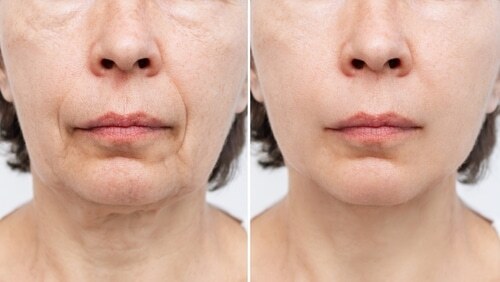 Face Lift in Buffalo, NY