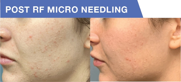 Exosome Therapy in Buffalo, NY | Unlock Radiant & Youthful Skin