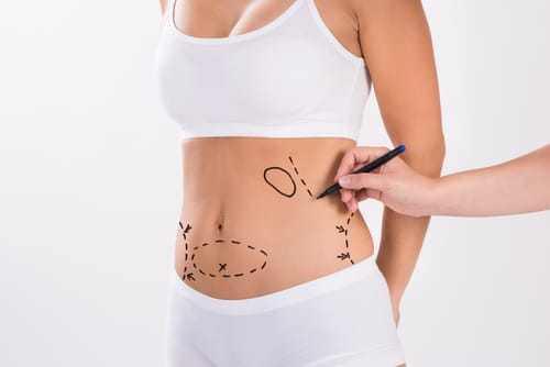 Liposuction in Nova Scotia: Sculpt Your Dream Body with Our Trusted Surgeons