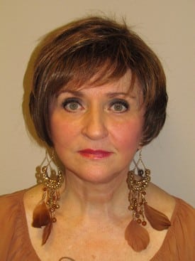 68 year old Facelift, Upper and Lower eyelift and necklift.