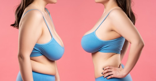 Breast Lift in Buffalo, NY