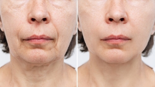 Face Lift in Buffalo, NY