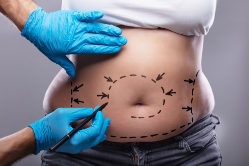 Bruggeman Plastic Surgery & Aesthetics - Flank #liposuction is a minimal  invasive outpatient procedure that removes fat around the sides and back of  the waste line. We perform this procedure in office