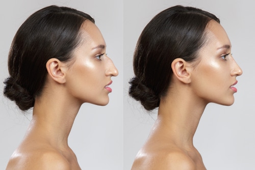 Nose Surgery in Buffalo, NY