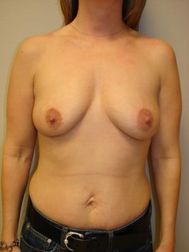 Mommy makeover breast augmentation and tummy tuck