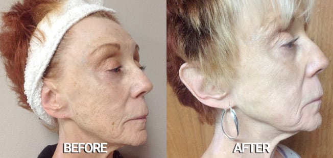 Fractionated Laser Resurfacing in Buffalo, NY