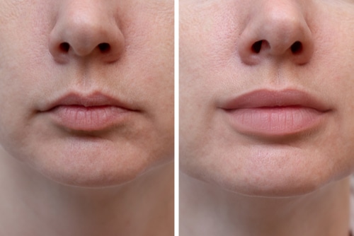 Lip Filler in Buffalo, NY Lip Injections Dr. Samuel Shatkin Jr.