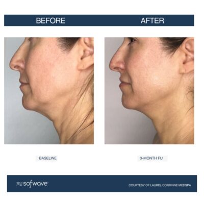 Sofwave Skin Tightening in Buffalo, NY | Revitalize Your Skin Today