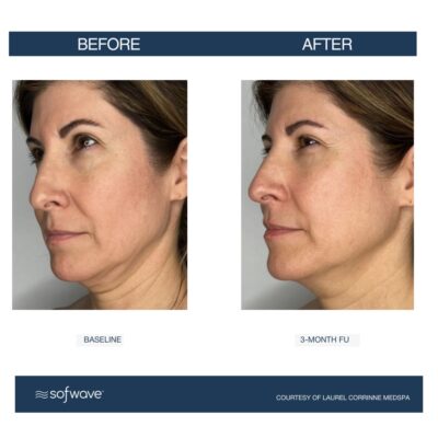 Sofwave in Buffalo, NY | Experience Non-Invasive Skin Tightening!
