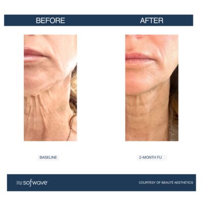 Sofwave in Buffalo, NY | Experience Non-Invasive Skin Tightening!