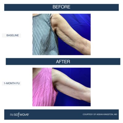 Sofwave in Buffalo, NY | Experience Non-Invasive Skin Tightening!