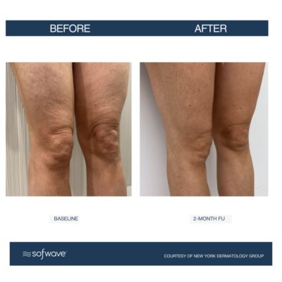Sofwave in Buffalo, NY | Experience Non-Invasive Skin Tightening!