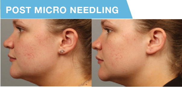 Exosome Therapy in Buffalo, NY | Unlock Radiant & Youthful Skin