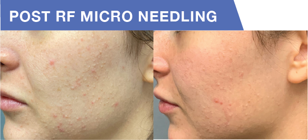 Exosome Therapy in Buffalo, NY | Unlock Radiant & Youthful Skin