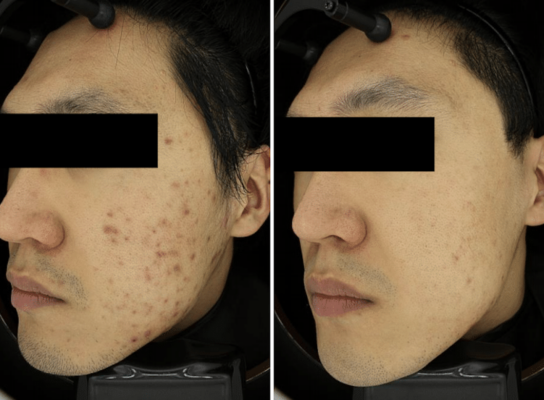 Exosome Therapy in Buffalo, NY | Unlock Radiant & Youthful Skin