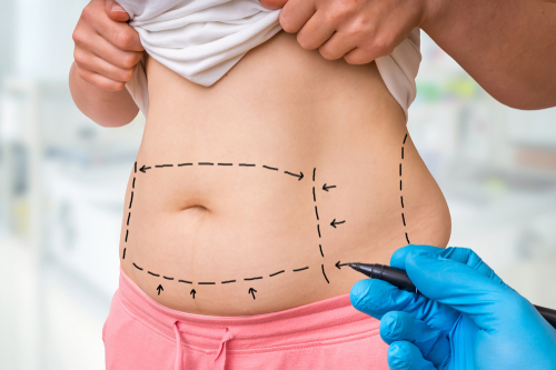 Mini Tummy Tuck in Buffalo, NY | Aesthetic Associates Centre