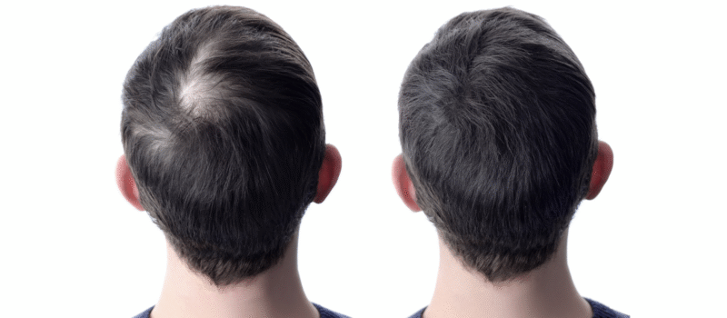 Gr8 RESTORE Hair Loss Treatment in Buffalo, NY